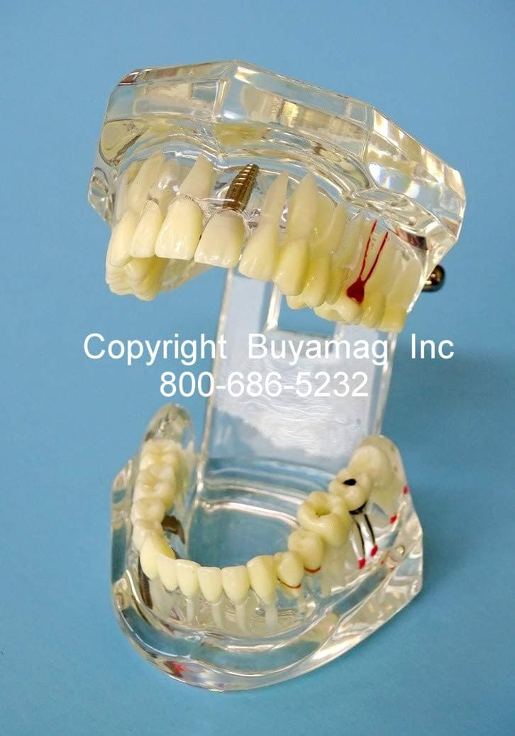 Dental Models Bridge IMPLANT Veneer Restoration Education Schools Teaching Training