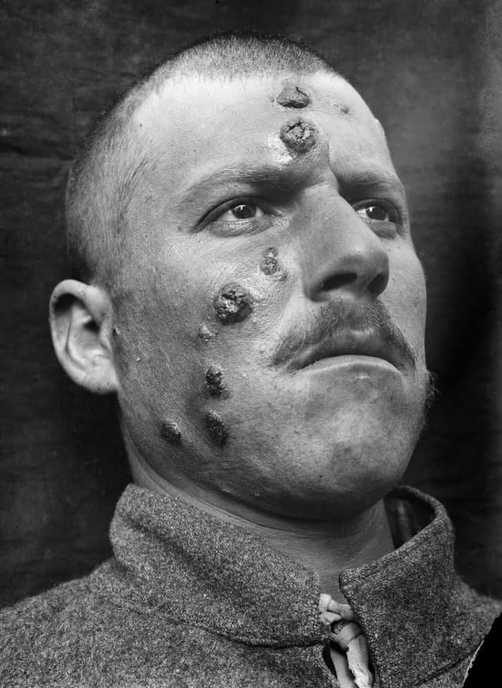 Skin Infection 1917 Na Middle Eastern Man Affected With The Parasitic Disease Cutaneous Leishmaniasis 1917 Known Locally As Jericho Buttons Poster Print by (18 x 24)